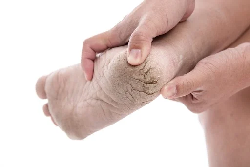 Gót chân bị nứt đen là tình trạng da phổ biến vào mùa đông khô hanh, lạnh hoặc là dấu hiệu của tình trạng bệnh lý nào đó. Chân bị nứt nẻ, chảy máu có thể gây đau đớn, ảnh hưởng tới việc di chuyển và cuộc sống sinh hoạt của người bệnh.